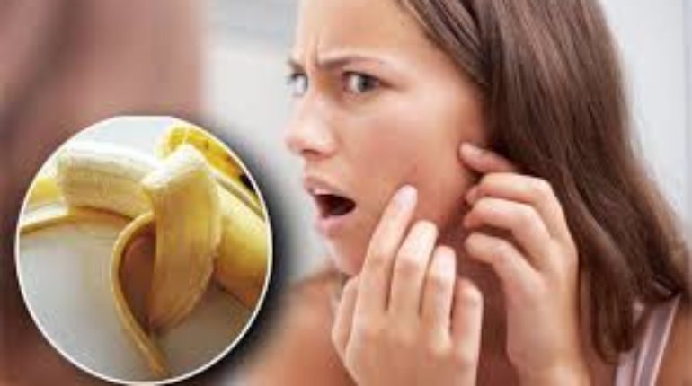 Banana Peels Helps you In Getting Rid Of Acne And Wrinkles Of The Face